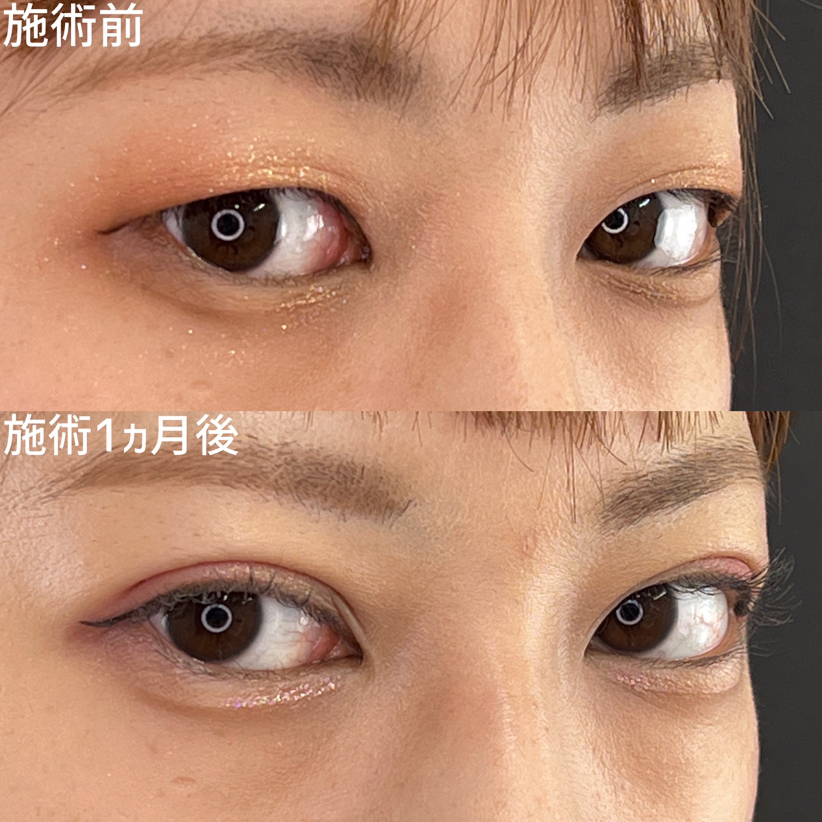 二重埋没法/目元：その他の症例写真 施術前後 
