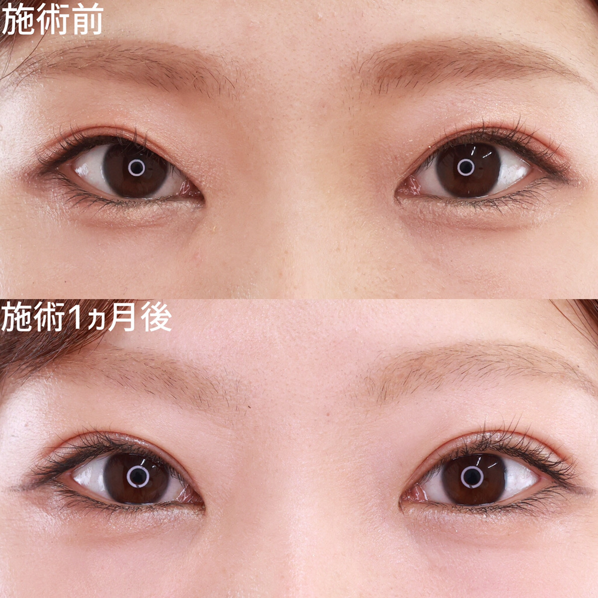 二重埋没法/目元:その他の症例写真 施術前後