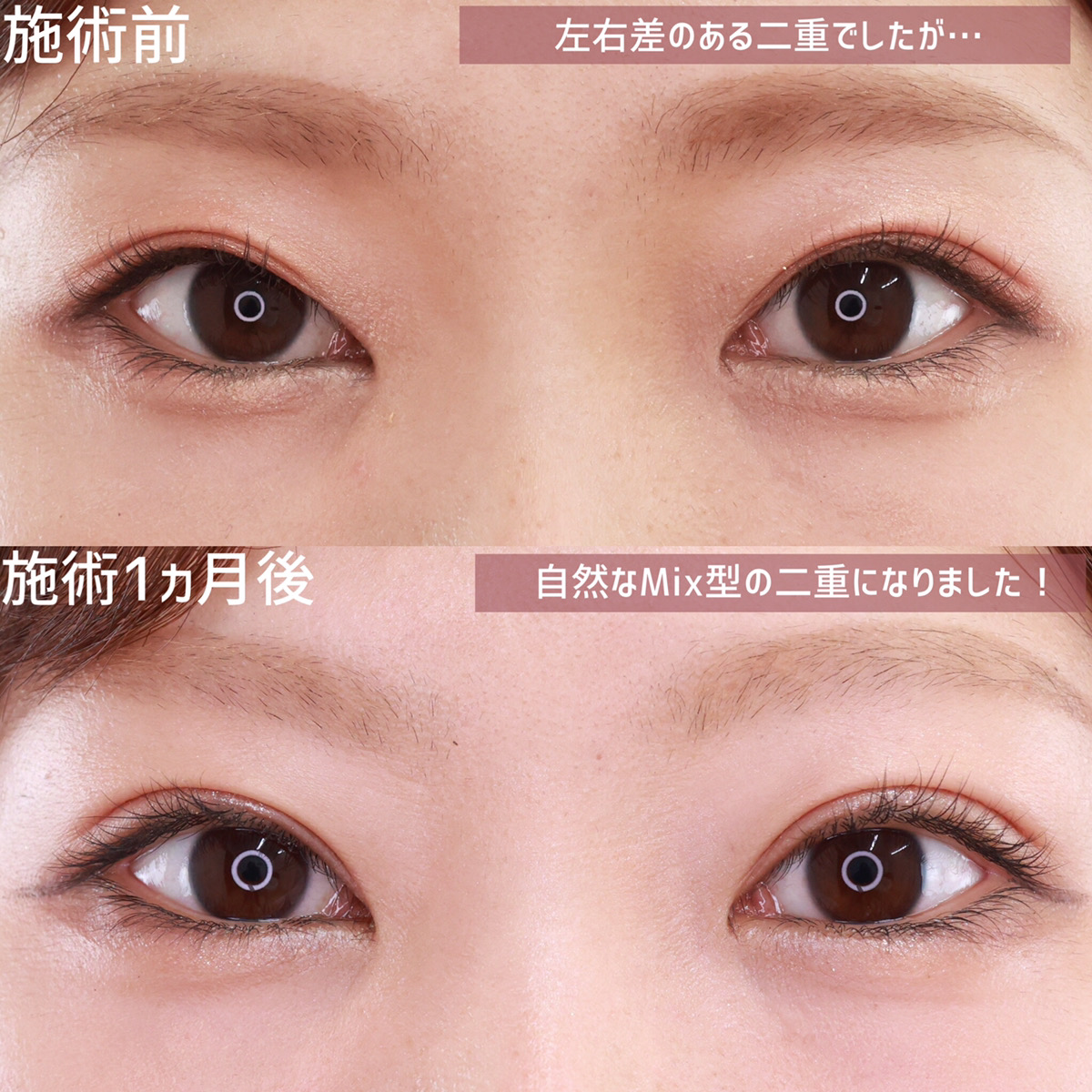 二重埋没法/目元:その他の症例写真 施術前後