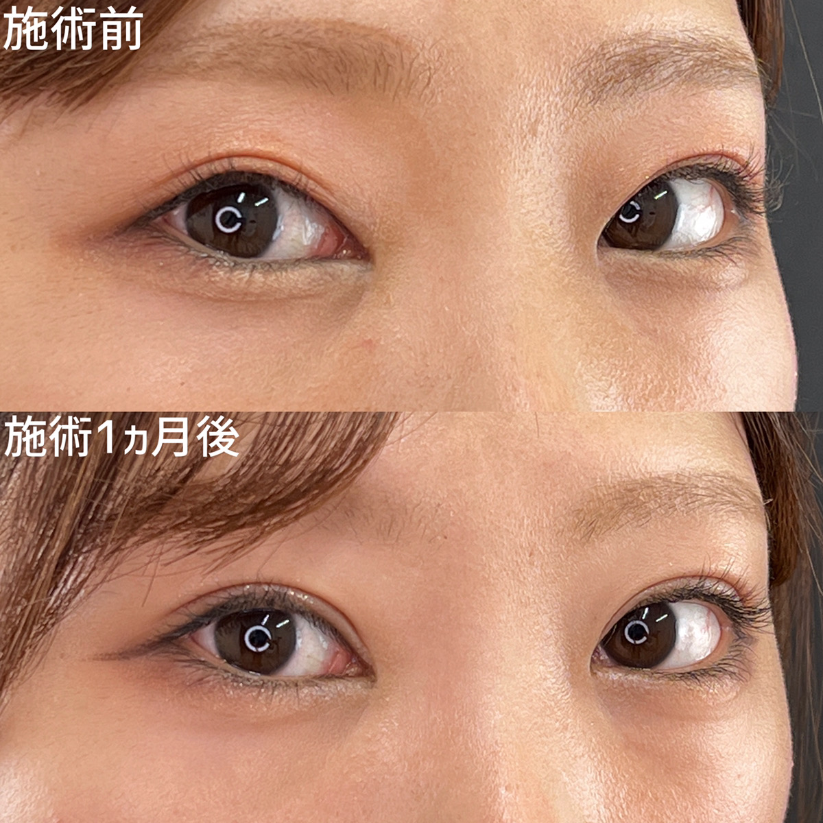 二重埋没法/目元:その他の症例写真 施術前後