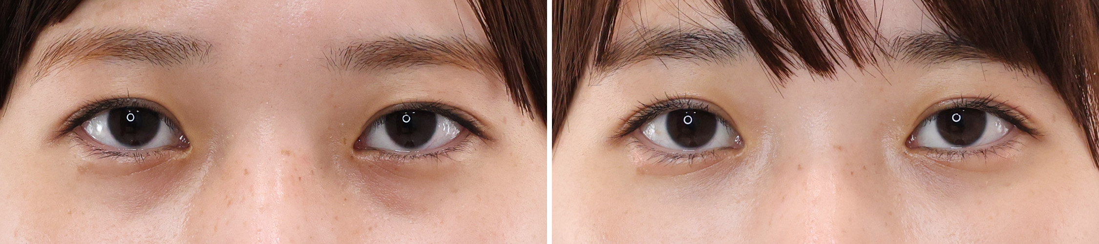 下眼瞼脱脂術（目の下のたるみ取り・目の下の脂肪ふくらみ取り）/顔の脂肪注入(コンデンスリッチフェイス)の症例写真 施術前後 １ヵ月