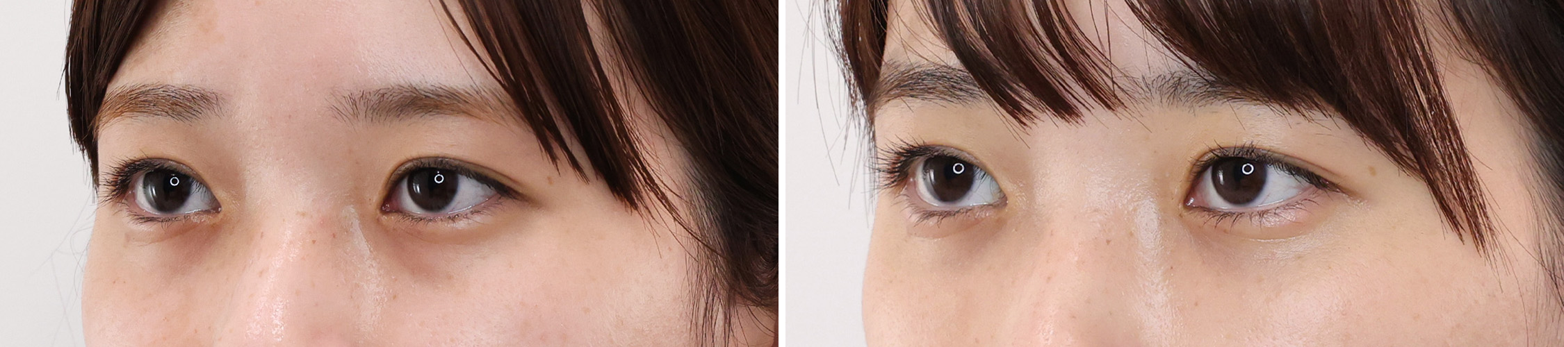 下眼瞼脱脂術（目の下のたるみ取り・目の下の脂肪ふくらみ取り）/顔の脂肪注入(コンデンスリッチフェイス)の症例写真 施術前後 １ヵ月