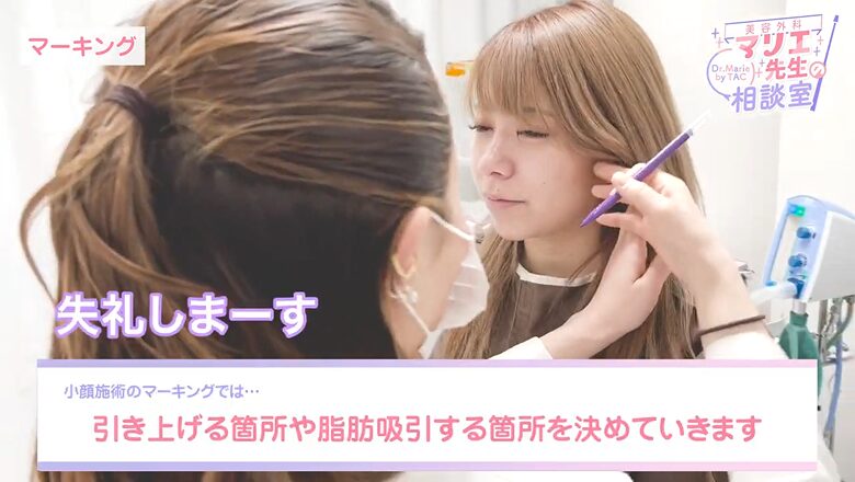 小顔施術のマーキングで引き上げ箇所と脂肪吸引箇所を決める様子