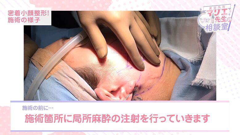 小顔施術前に施術箇所へ局所麻酔の注射を行う様子