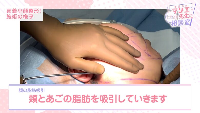 頬と顎の脂肪吸引で顔の脂肪を取り除く施術シーン