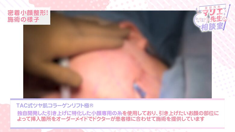 TAC式ツヤ肌コラーゲンリフト極で小顔専用の糸を挿入する施術シーン