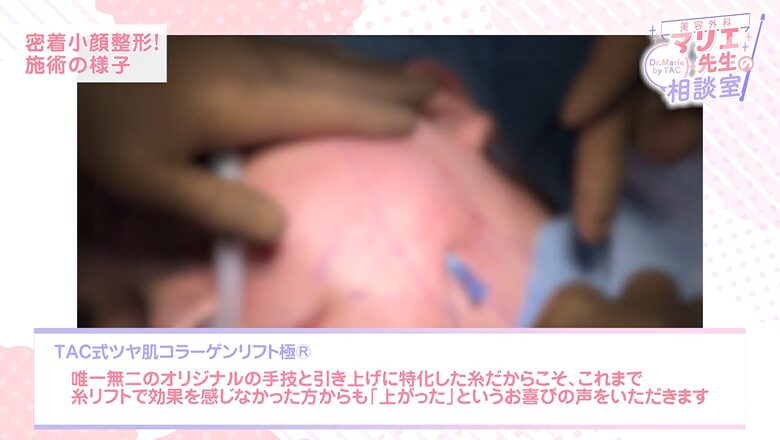 TAC式ツヤ肌コラーゲンリフト極による引き上げに特化した糸リフトの施術