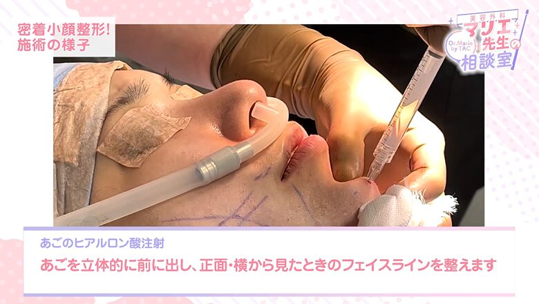 顎のヒアルロン酸注射で立体的なフェイスラインを整える施術