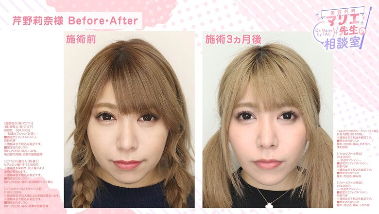 芹野莉奈さんの小顔施術ビフォーアフター3ヶ月経過の比較写真