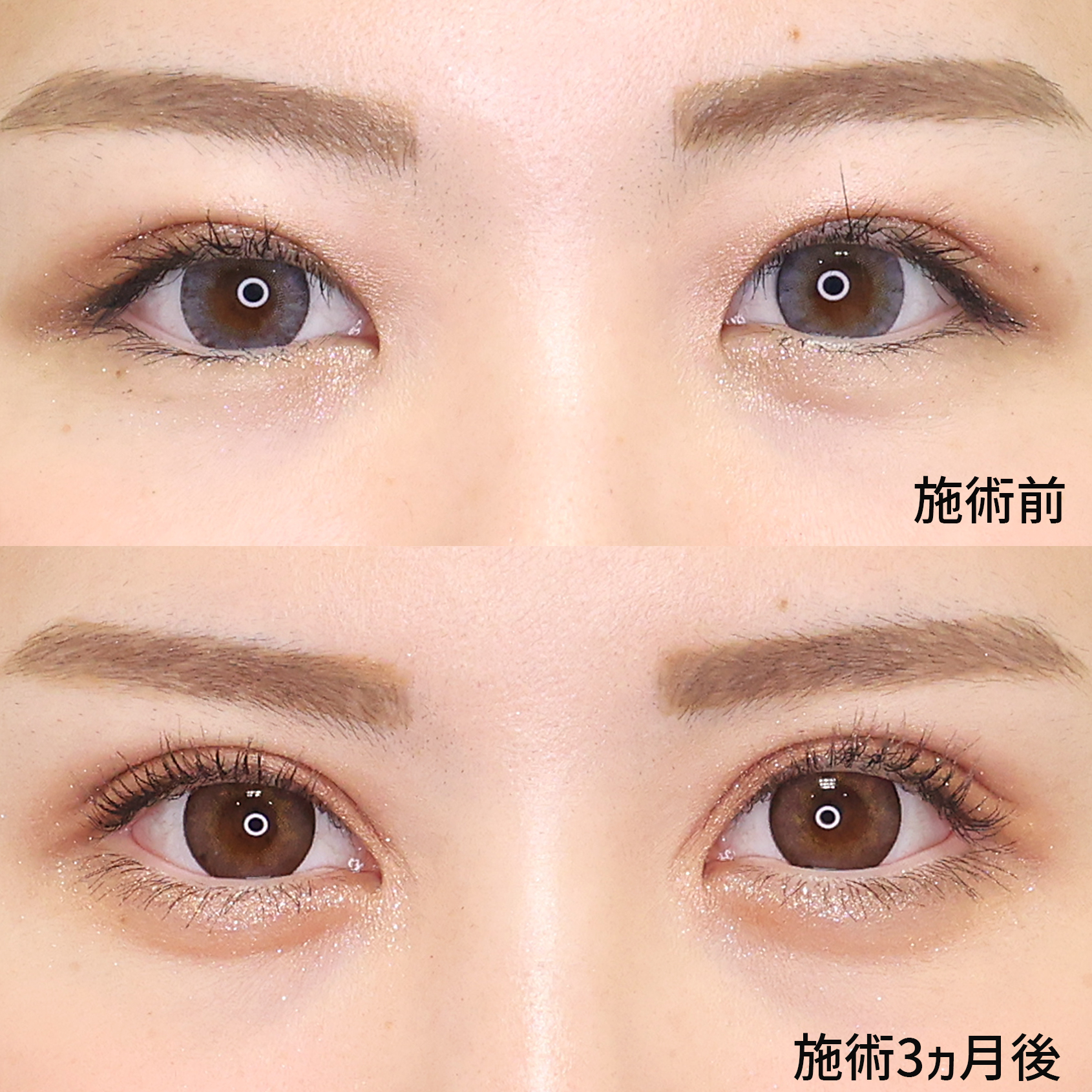 二重切開(全切開法)/目頭切開術/目尻切開術の症例写真 施術前後