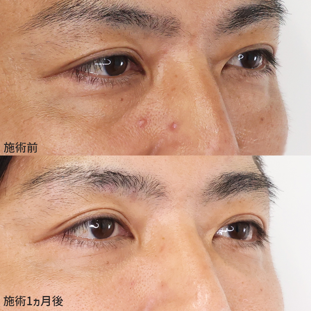 下眼瞼脱脂術(目の下のたるみ取り・目の下の脂肪ふくらみ取り)の症例写真 施術前後