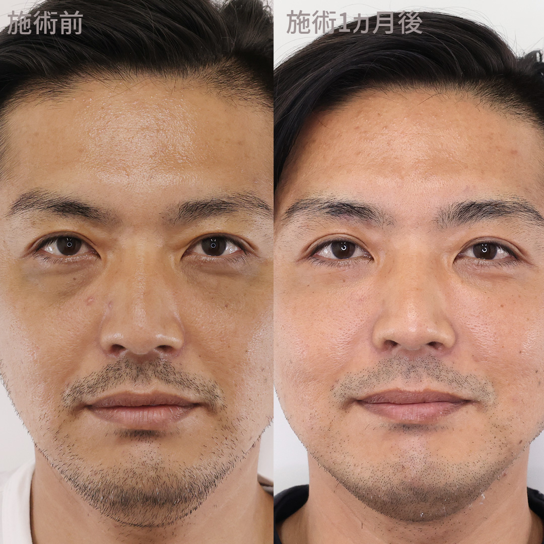 下眼瞼脱脂術(目の下のたるみ取り・目の下の脂肪ふくらみ取り)の症例写真 施術前後