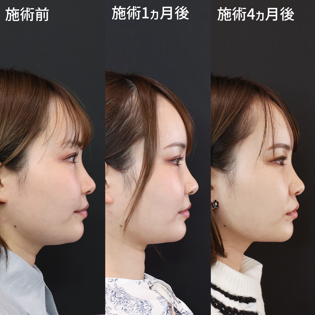 小顔整形｜パーフェクトフェイスライン/顔の脂肪吸引/TAC式 ツヤ肌コラーゲンリフト®の症例写真 施術前後 