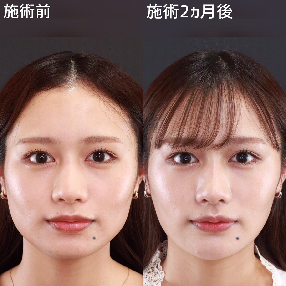 糸リフトで早めのエイジングケア