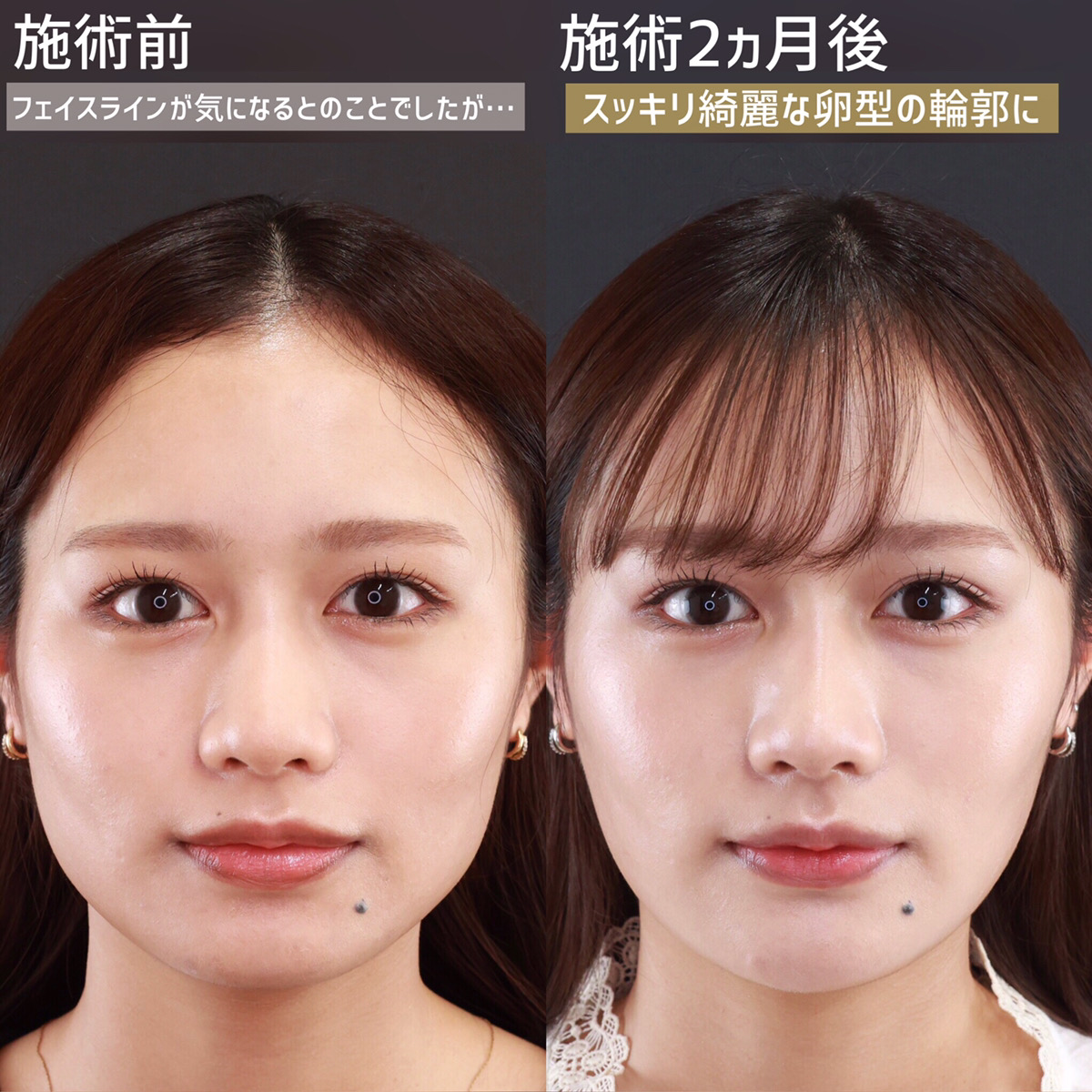 TAC式 ツヤ肌コラーゲンリフト®/顎のヒアルロン酸注射/エラボトックス注射の症例写真 施術前後