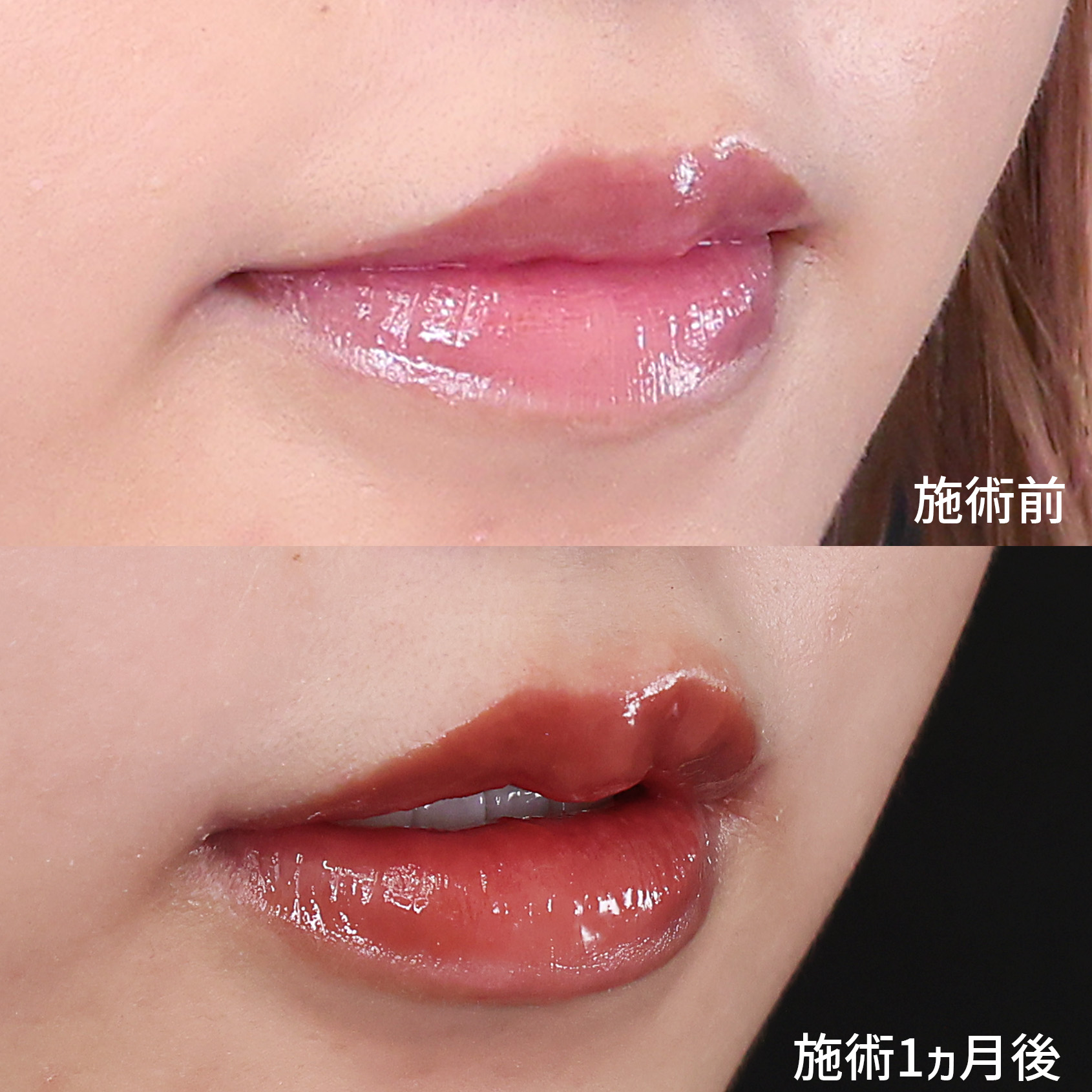 口角挙上・リフト（マイクロ切開法・内側法/口内法）/M字リップ形成術の症例写真 施術前後 １ヵ月