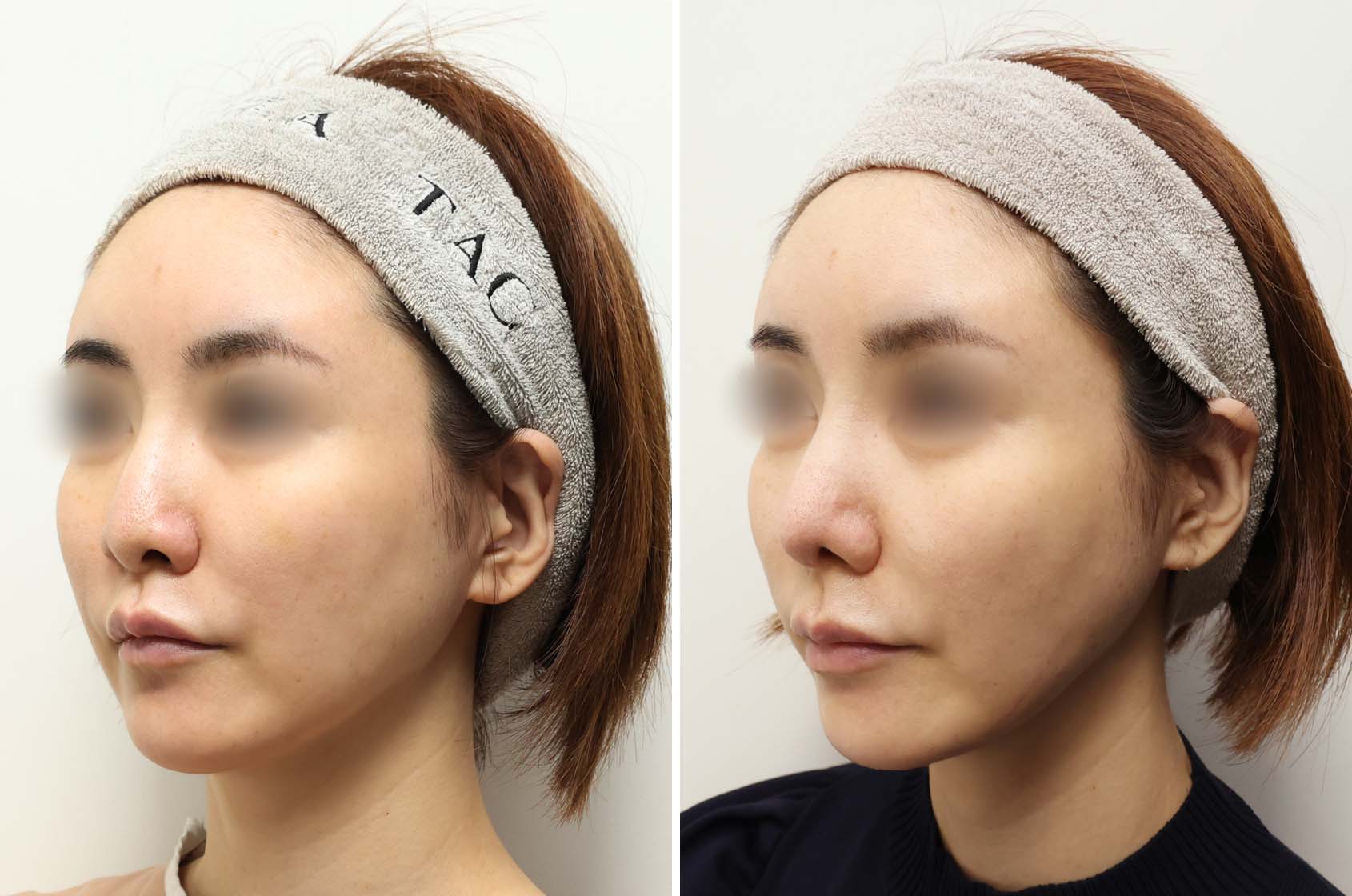 スッと伸びた理想的な鼻先へアップデート！