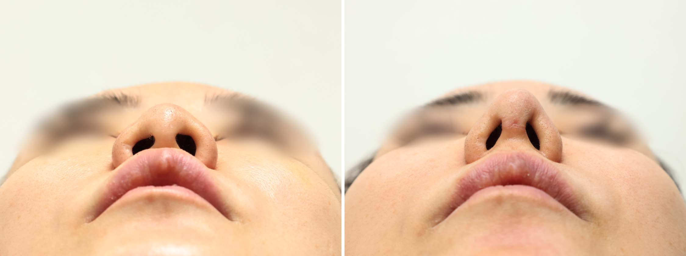 鼻中隔延長術/鼻尖形成・鼻尖縮小/鼻先軟骨移植の症例写真 施術前後 1ヵ月