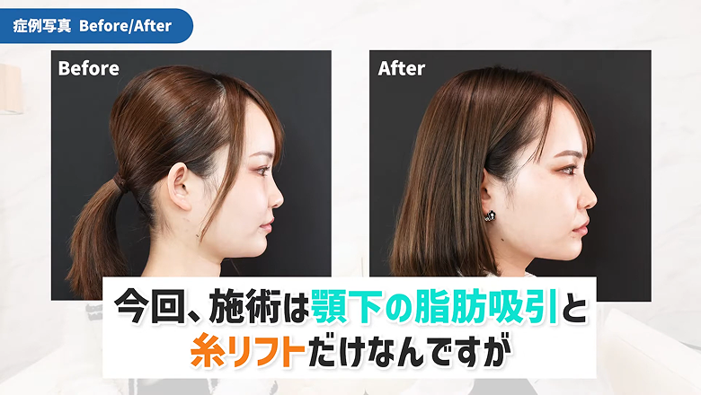顎下の脂肪吸引と糸リフトの術前と術後を並べた横顔写真