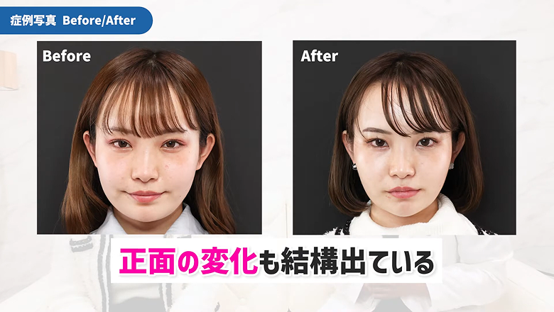 顎下の脂肪吸引と糸リフトの術前と術後を並べた正面写真