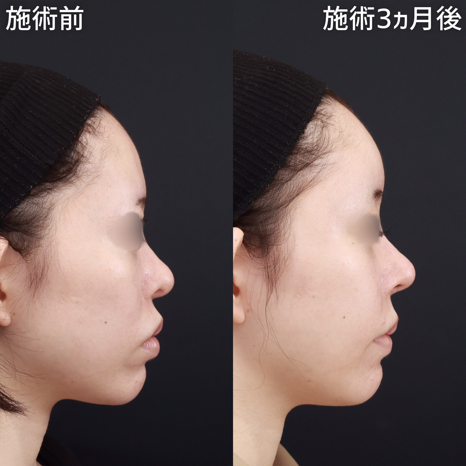 鼻中隔延長術/鼻先軟骨移植/隆鼻術(プロテーゼ・自家組織)の症例写真 施術前後