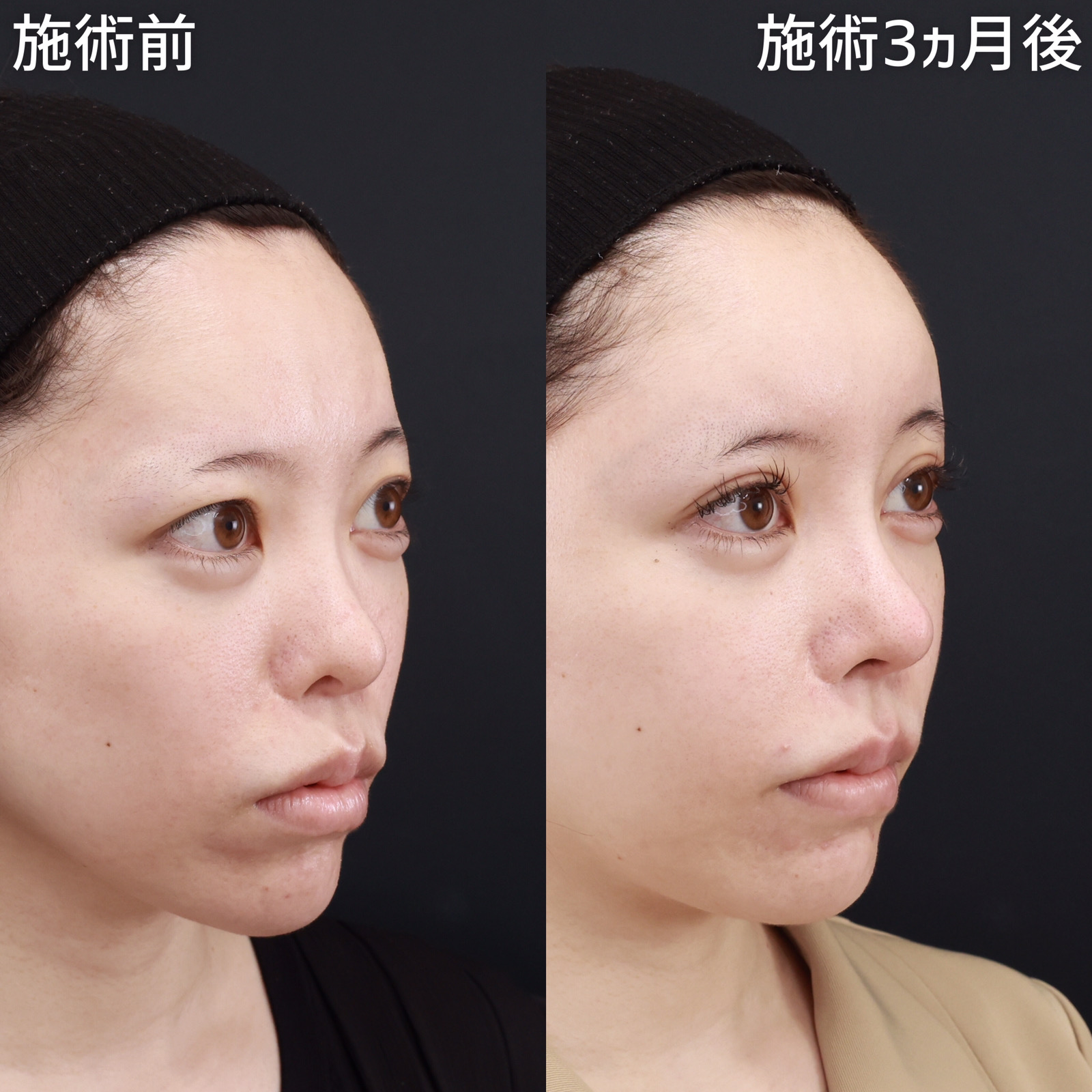 鼻中隔延長術/鼻先軟骨移植/隆鼻術(プロテーゼ・自家組織)の症例写真 施術前後