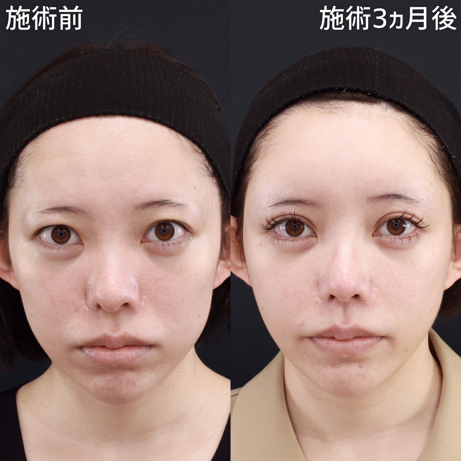 鼻中隔延長術/鼻先軟骨移植/隆鼻術(プロテーゼ・自家組織)の症例写真 施術前後