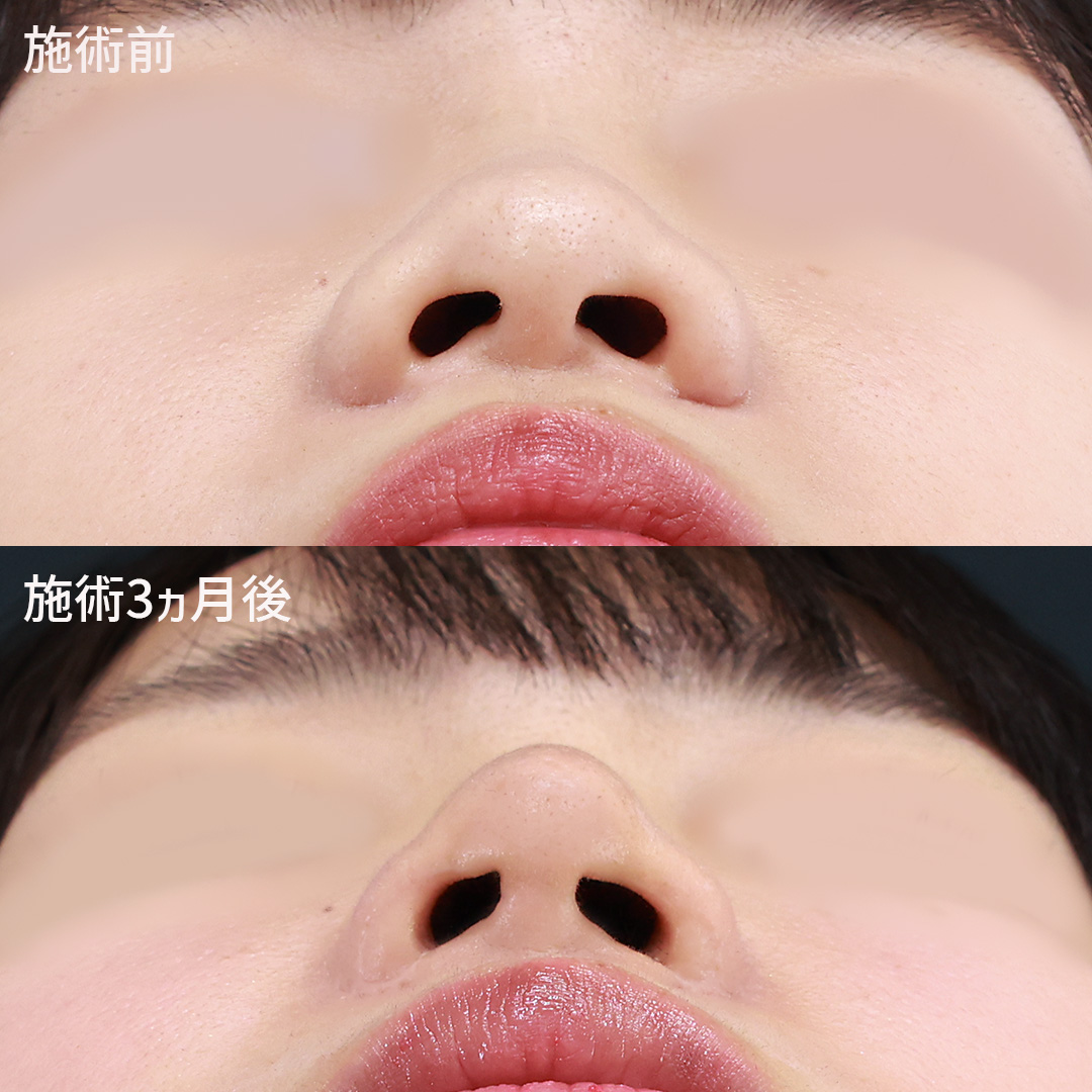 TAC式 鼻翼縮小術（小鼻縮小）/鼻孔縁挙上術/鼻尖形成・鼻尖縮小の症例写真 施術前後 