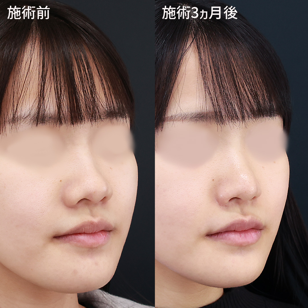 TAC式 鼻翼縮小術（小鼻縮小）/鼻孔縁挙上術/鼻尖形成・鼻尖縮小の症例写真 施術前後 