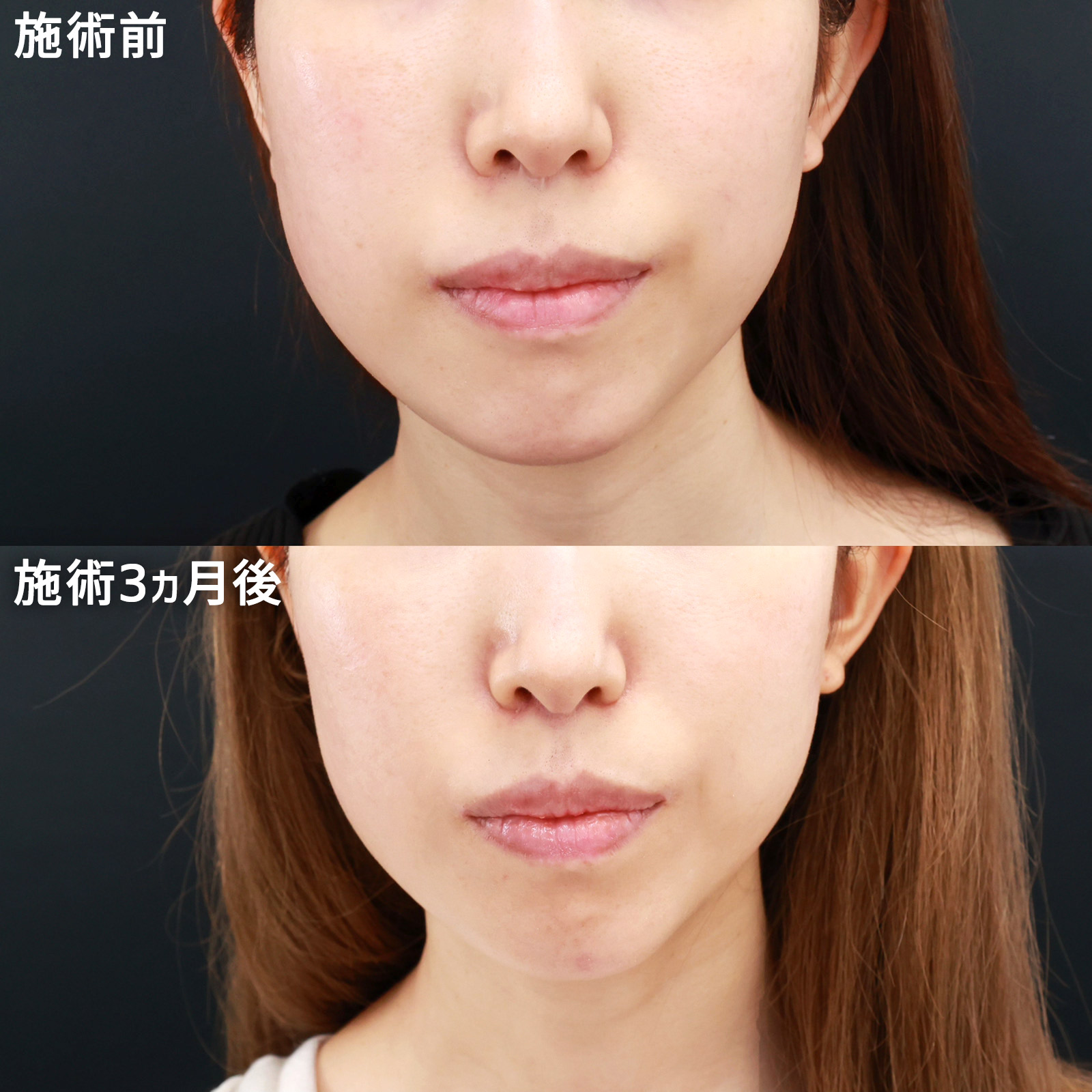 人中短縮術(リップリフト)・外側人中短縮術の症例写真 施術前後 3ヵ月