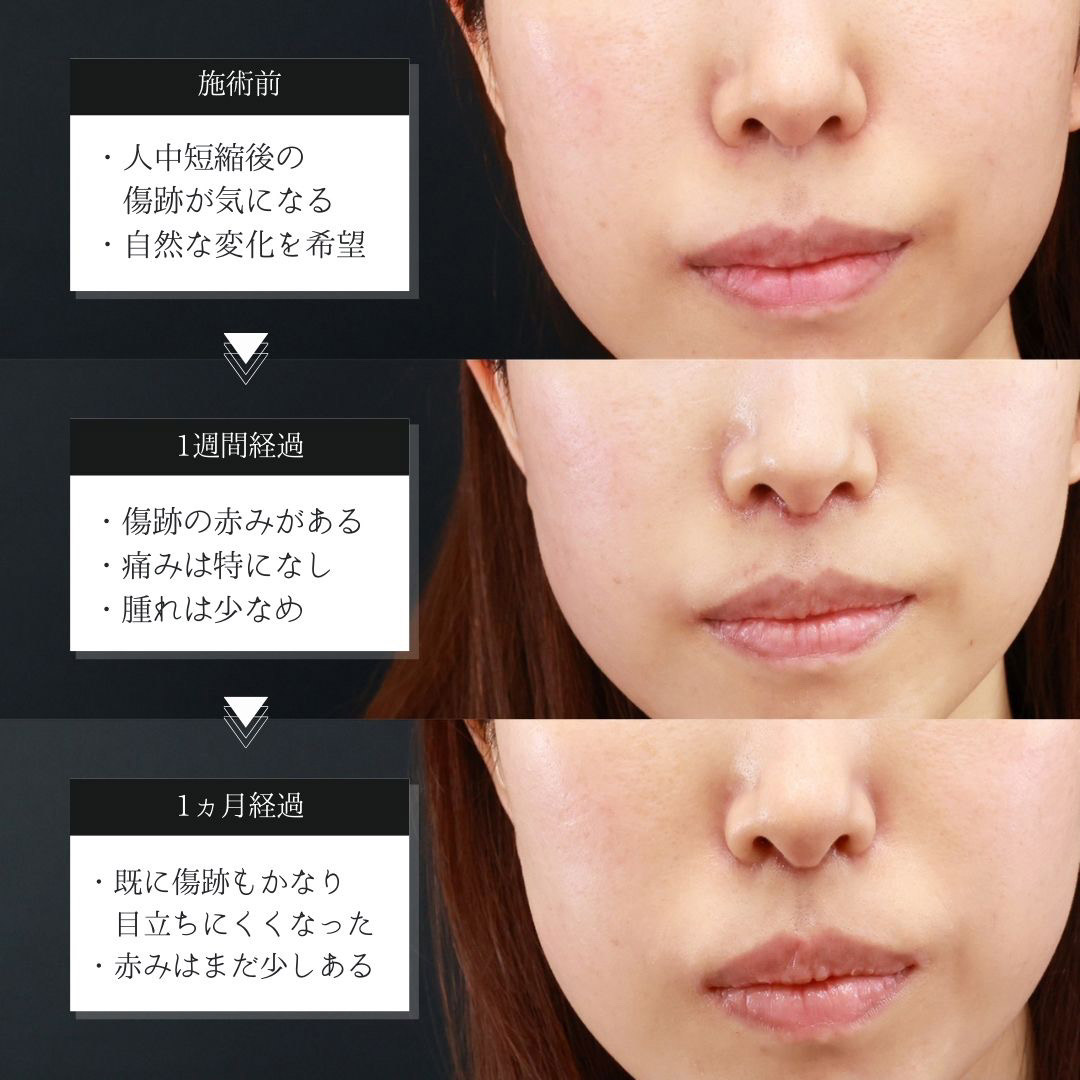 人中短縮術(リップリフト)・外側人中短縮術の症例写真 施術前後