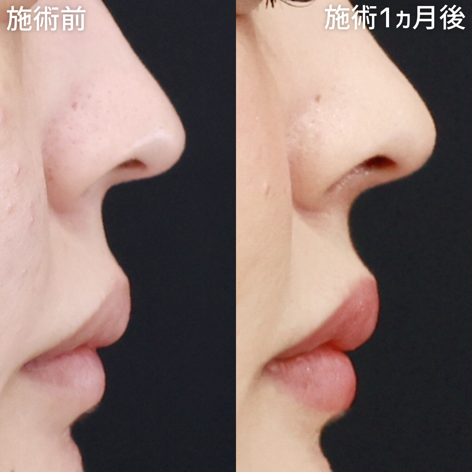 Cカール・猫手術の症例写真 施術前後 