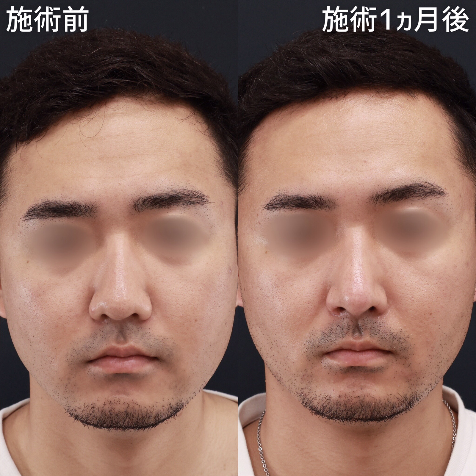 鼻中隔延長術/鼻尖形成・鼻尖縮小/鼻先軟骨移植の症例写真 施術前後 1ヵ月