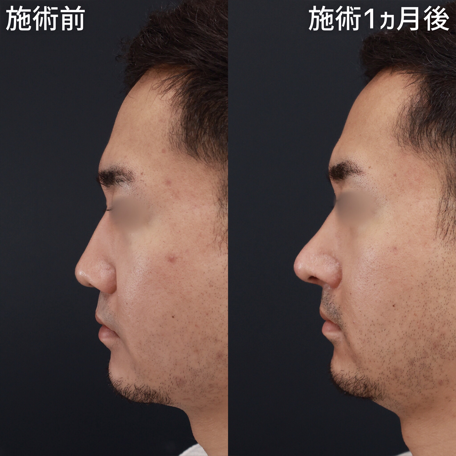 【鼻フル】鼻尖・鼻翼・鼻柱のバランスを整える