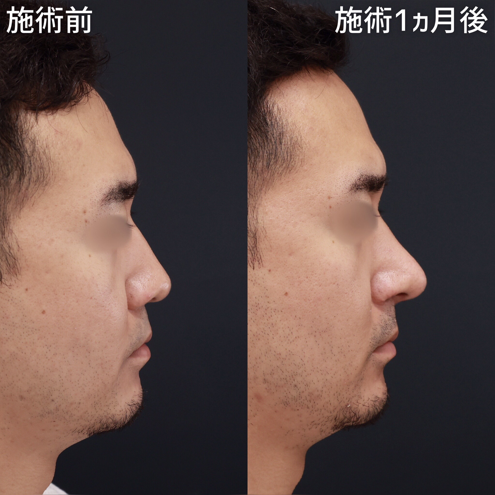 鼻中隔延長術/鼻尖形成・鼻尖縮小/鼻先軟骨移植の症例写真 施術前後 1ヵ月