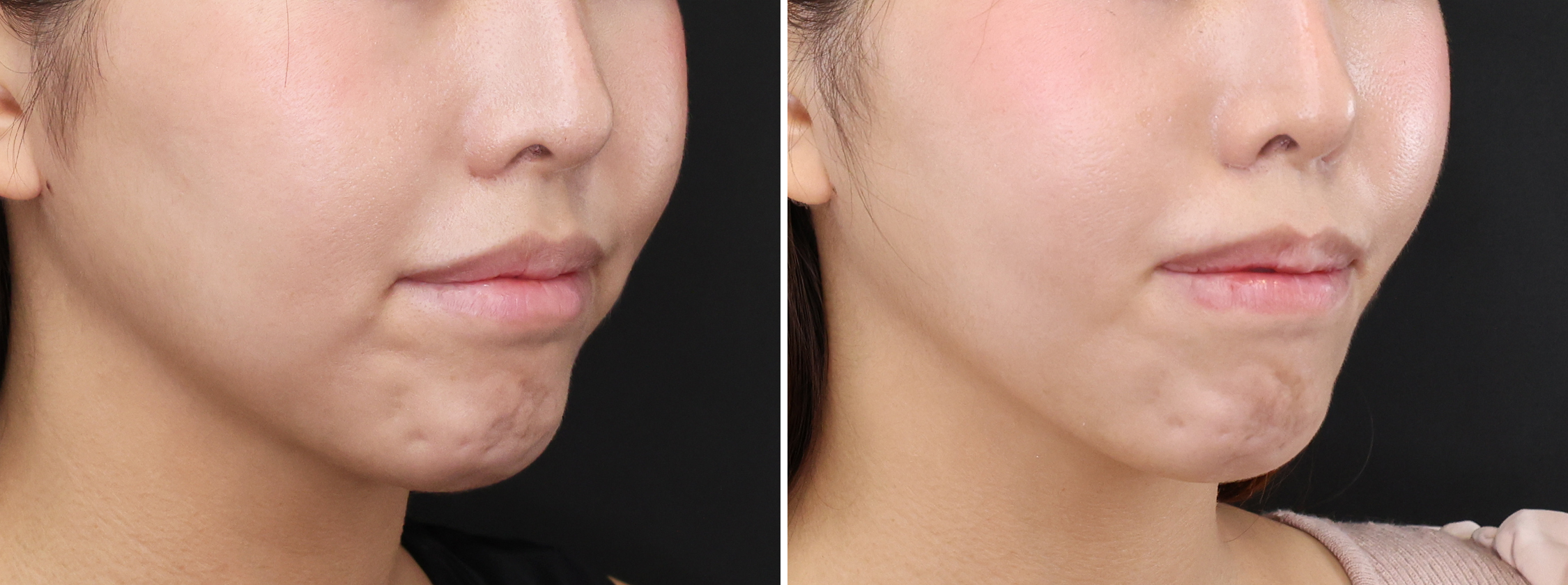 【2か所の脂肪除去×糸リフト】でスッキリとした口周りを実現！