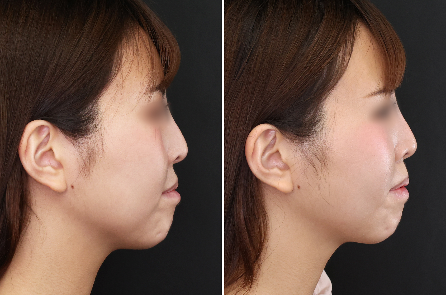 ジョールファット除去/メーラーファット除去/TAC式 ツヤ肌コラーゲンリフト®の症例写真 施術前後 １ヵ月