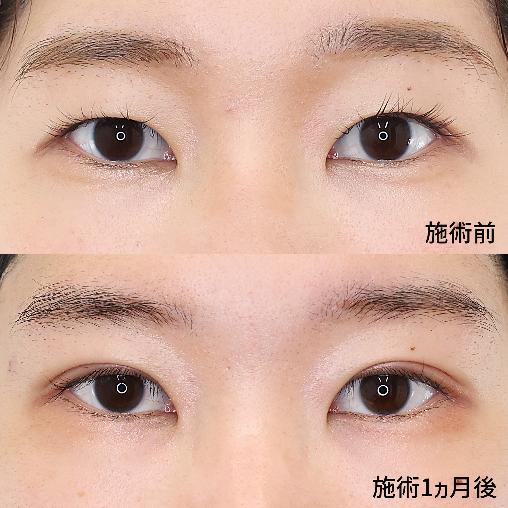 二重幅を広げて よりメイク映えする目元に