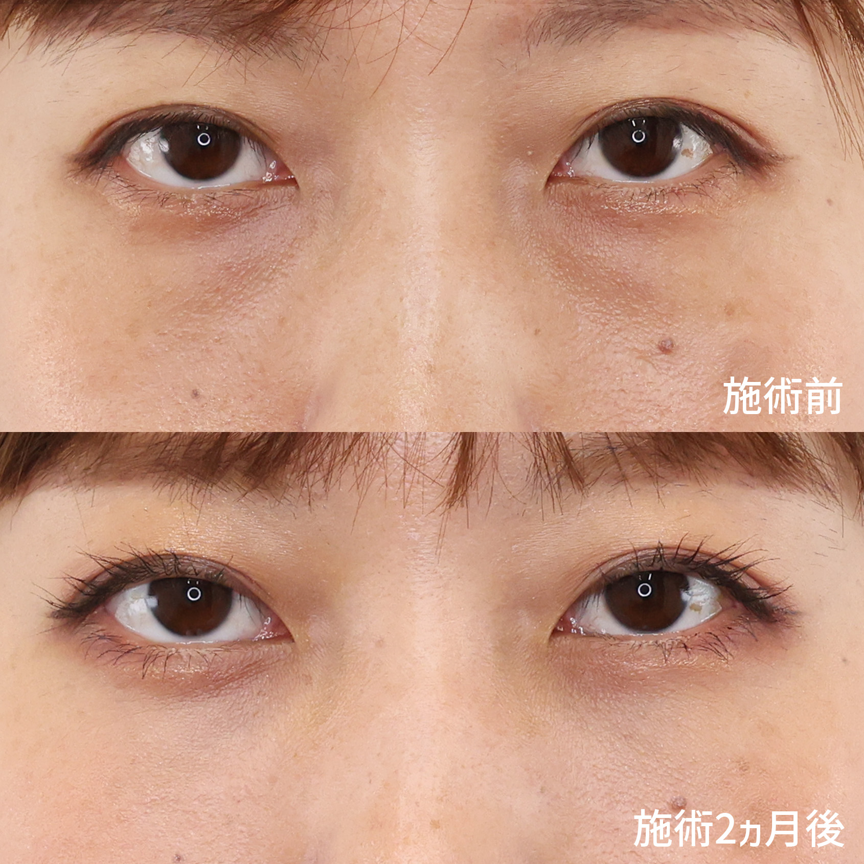 エイジングケアの新基準！【目の下のクマ取り】と【脂肪注入】で疲れた印象は改善できる