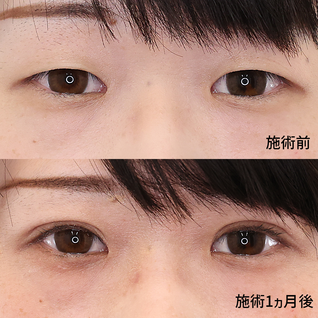 自然な仕上がりの二重埋没法で大人っぽい雰囲気に