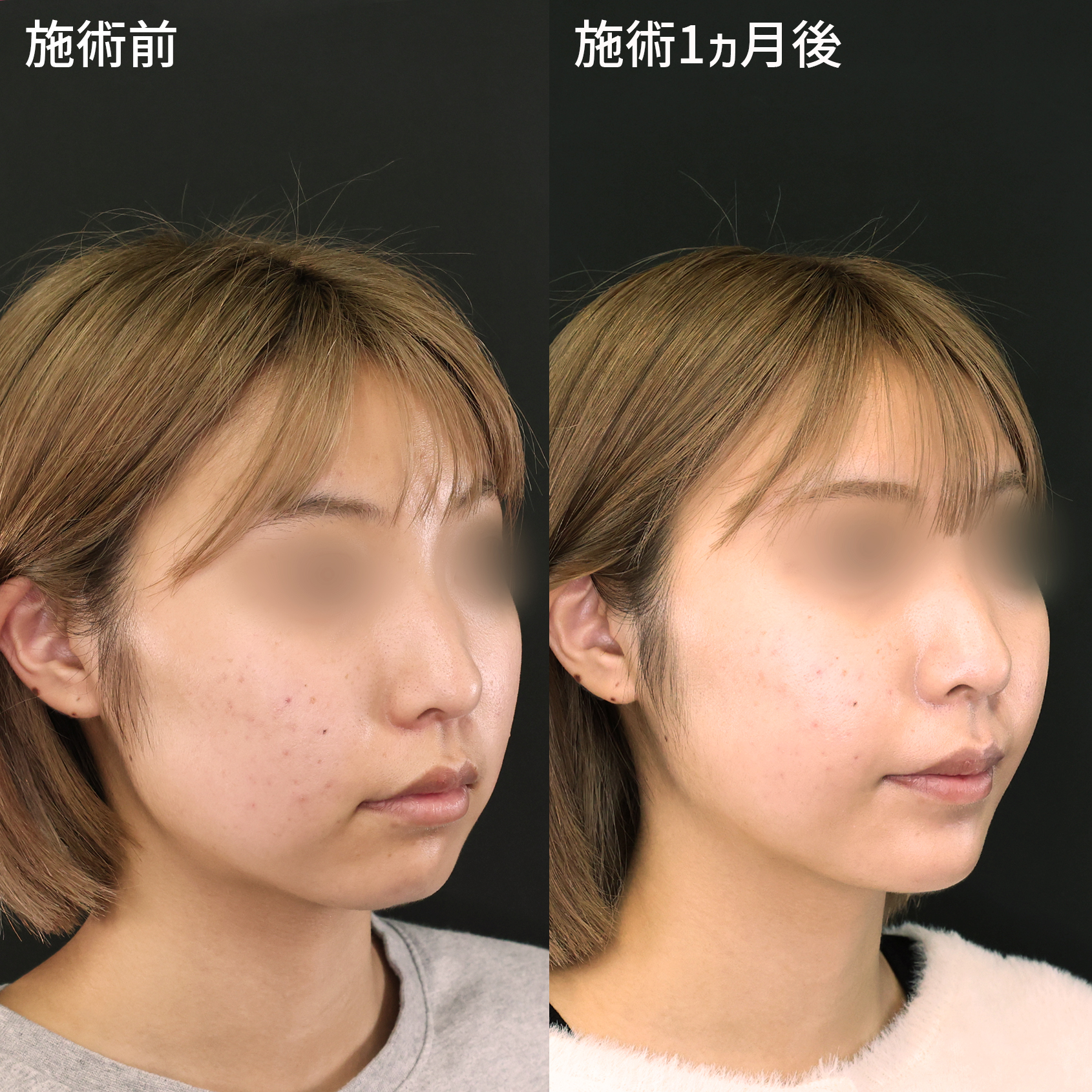小顔整形｜パーフェクトフェイスライン/ジョールファット除去/TAC式 ツヤ肌コラーゲンリフト®の症例写真 施術前後  施術前・施術１ヵ月後