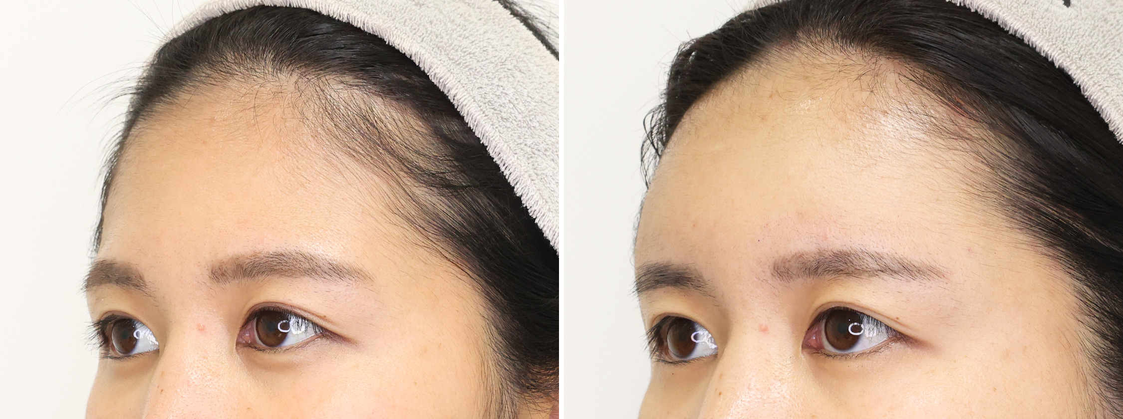 【額の脂肪注入】で丸みの美しいおでこが誕生