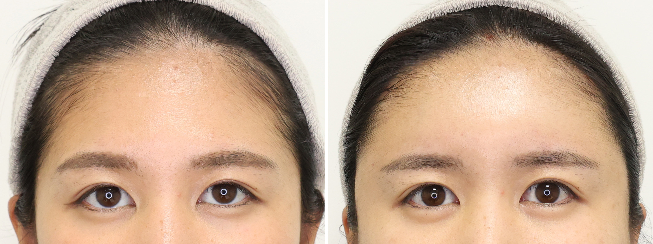 顔の脂肪注入(コンデンスリッチフェイス)の症例写真 施術前後 直後