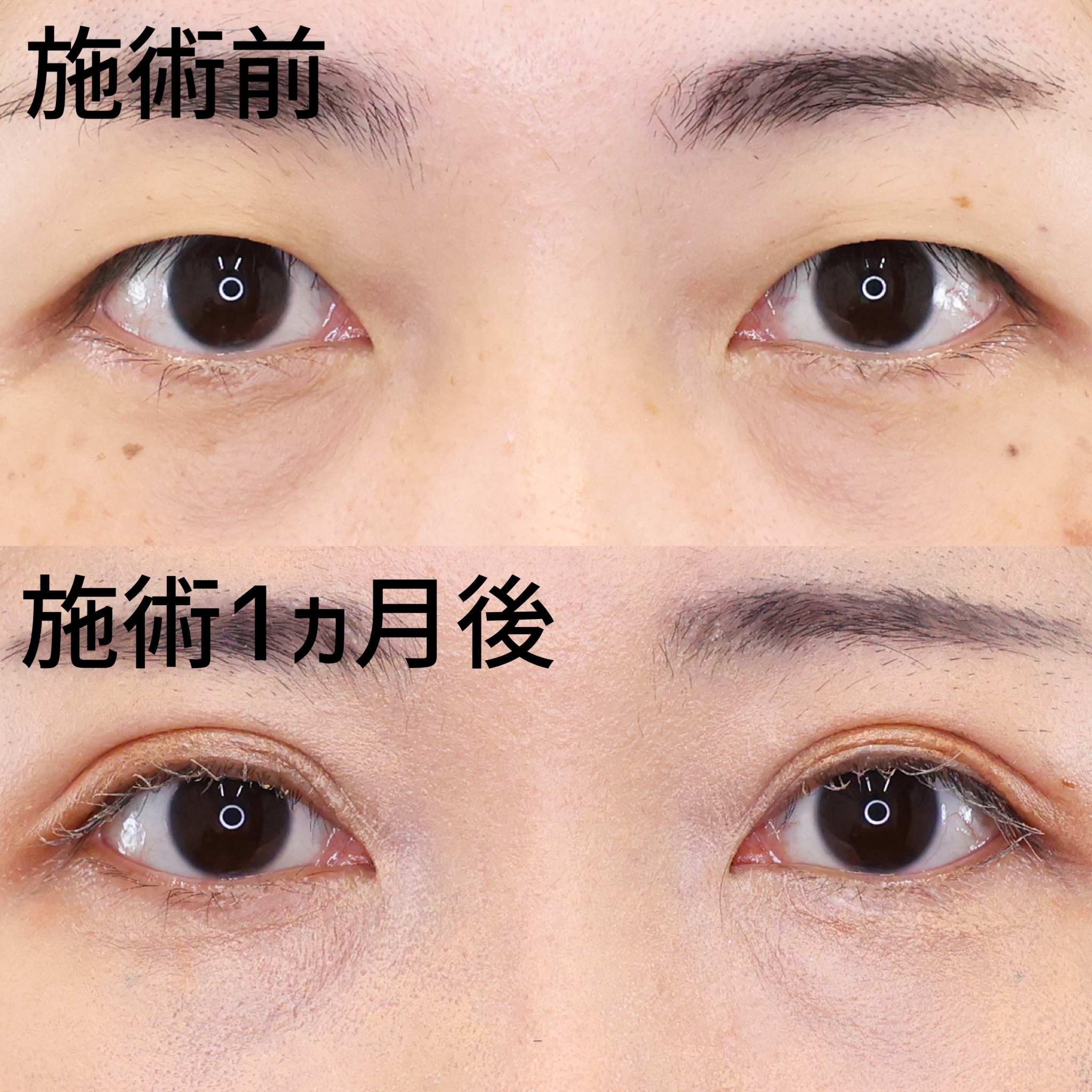 二重埋没法の症例写真 施術前後 1ヵ月