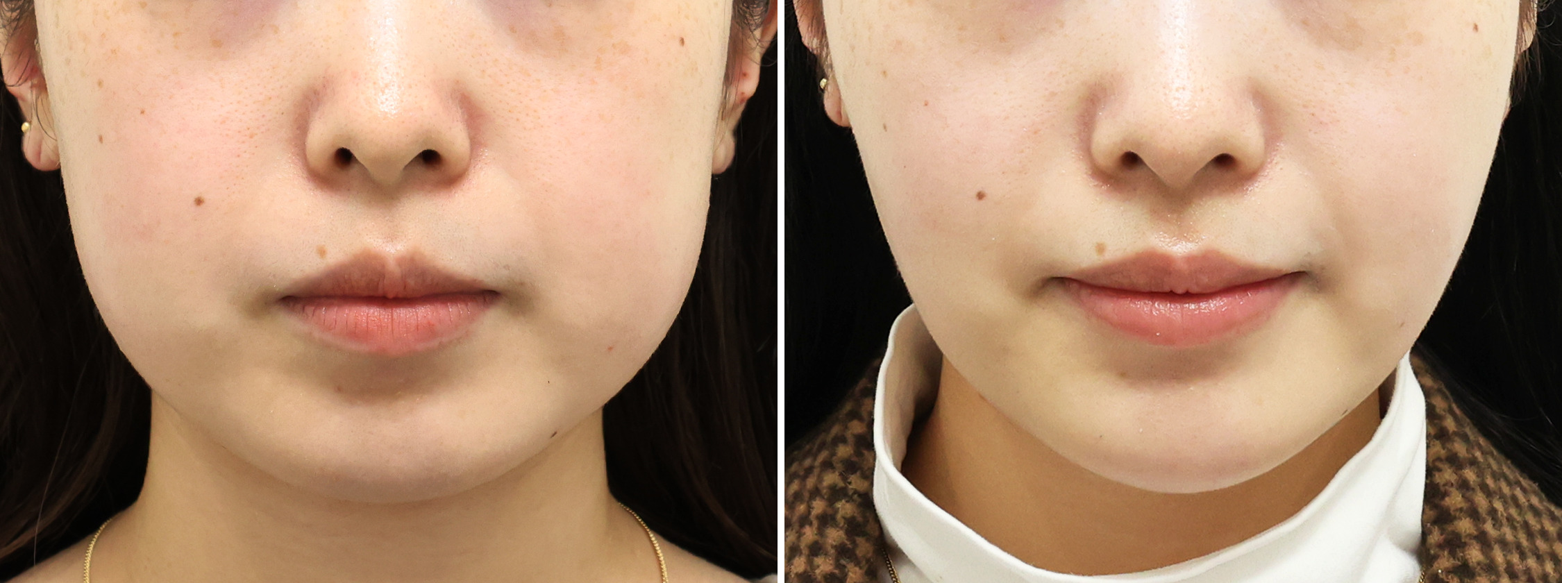 小顔整形｜パーフェクトフェイスラインの症例写真 施術前後 2ヵ月