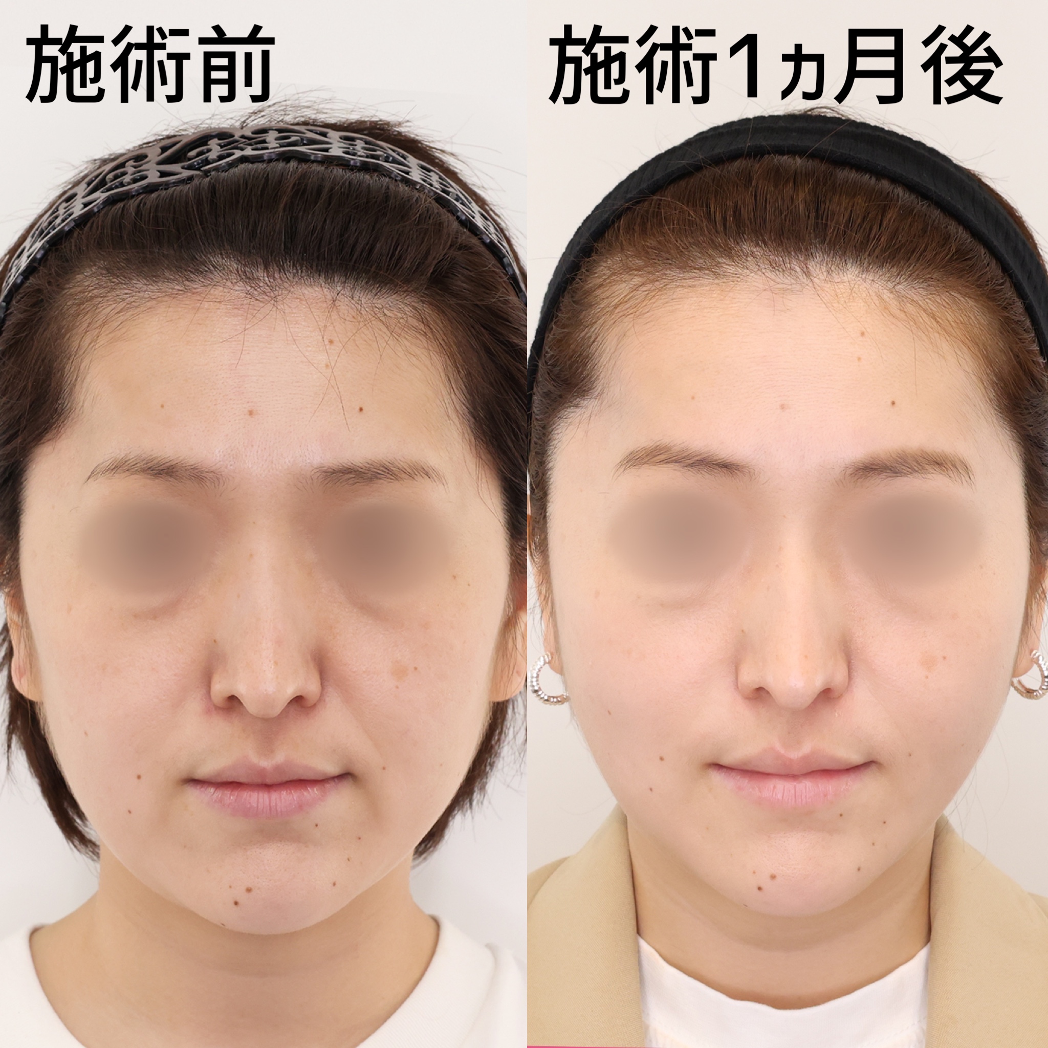 切らずにここまで変わる！複合施術でたるみのない小顔へ！