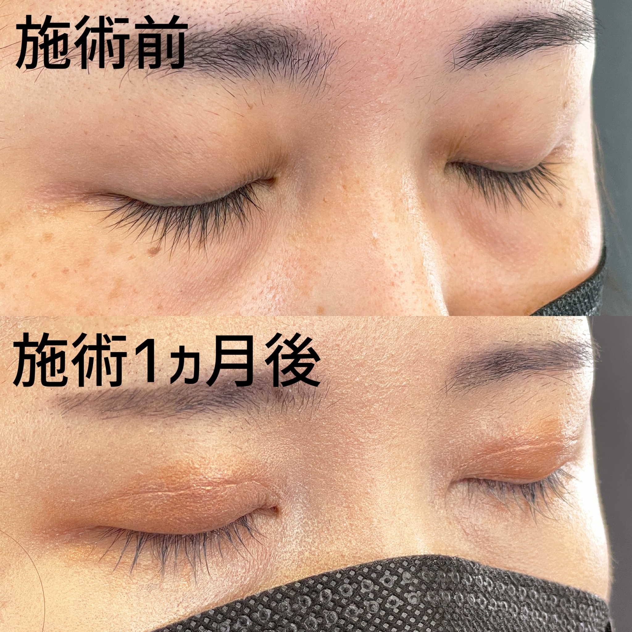 二重埋没法の症例写真 施術前後 1ヵ月