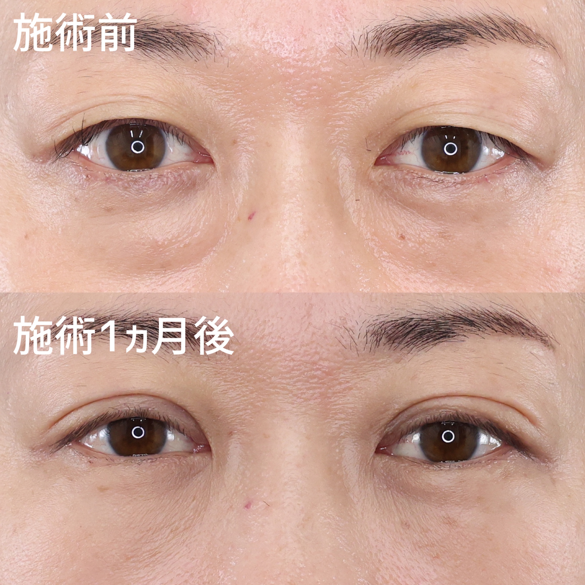 クマ取りと二重の組み合わせで若々しく印象的なお目元に！