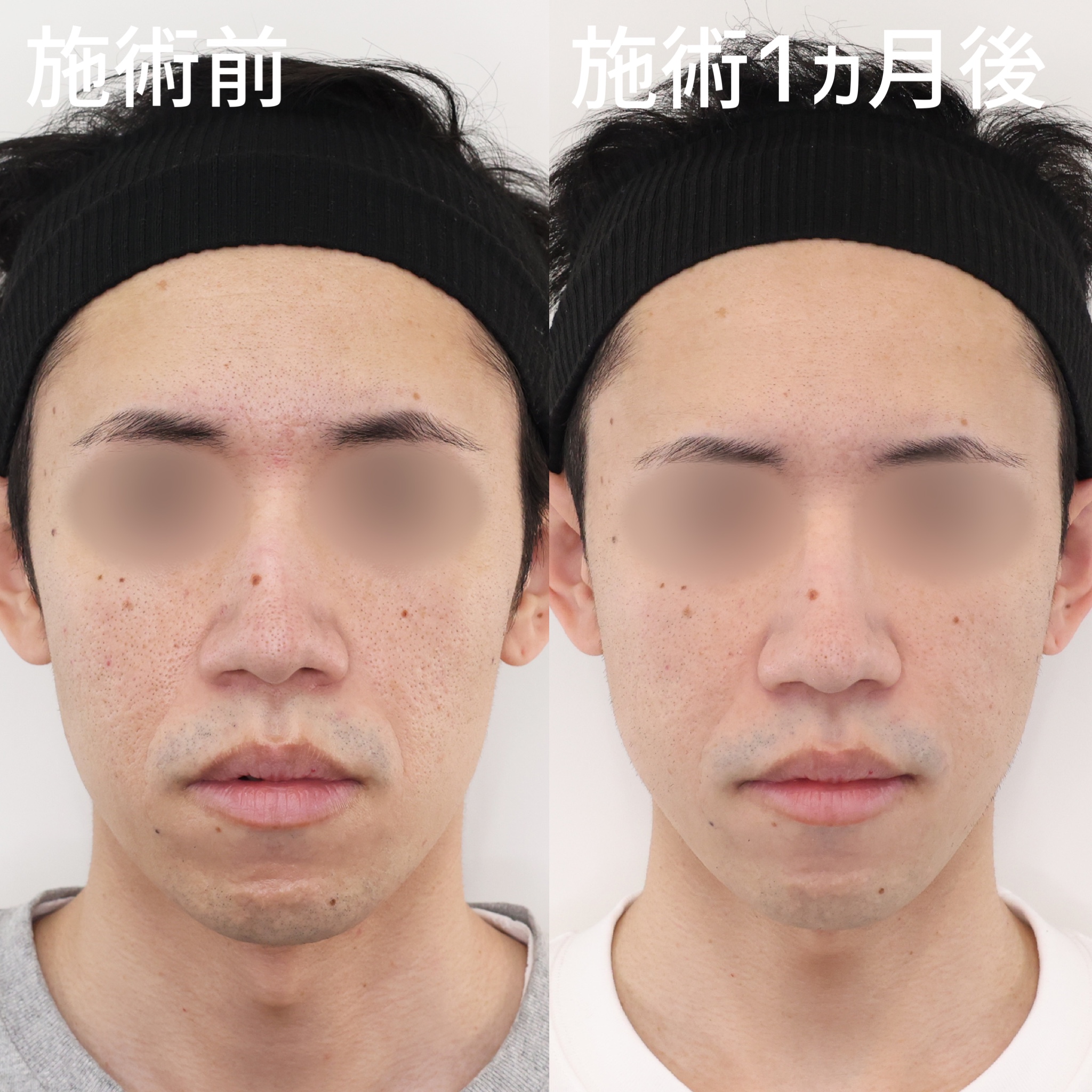 メンズも糸リフトで一回り小顔に！【TAC式ツヤ肌コラーゲンリフト®極】