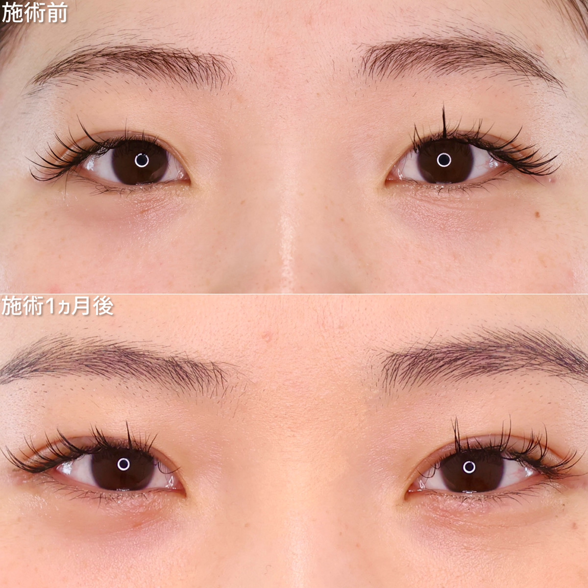 左右差を改善し、ぱっちり印象的なお目元へ